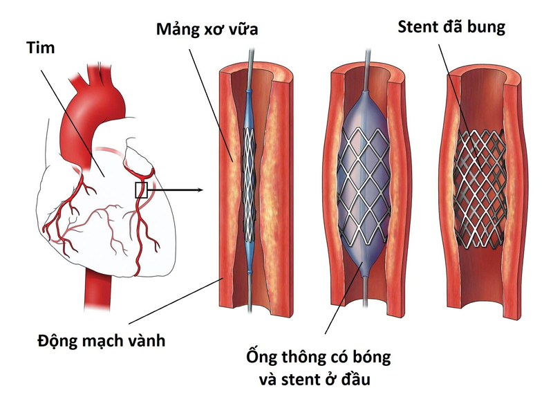 Đặt stent mạch vành-1
