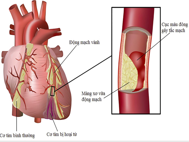 Đặt stent mạch vành-2