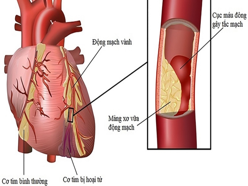 Suy mạch vành-1