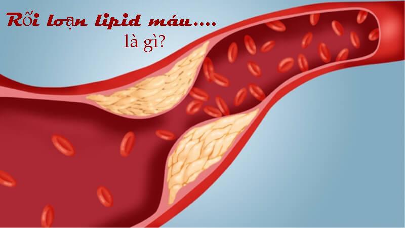 Rối loạn lipid máu và nguy cơ bệnh tim mạch-1