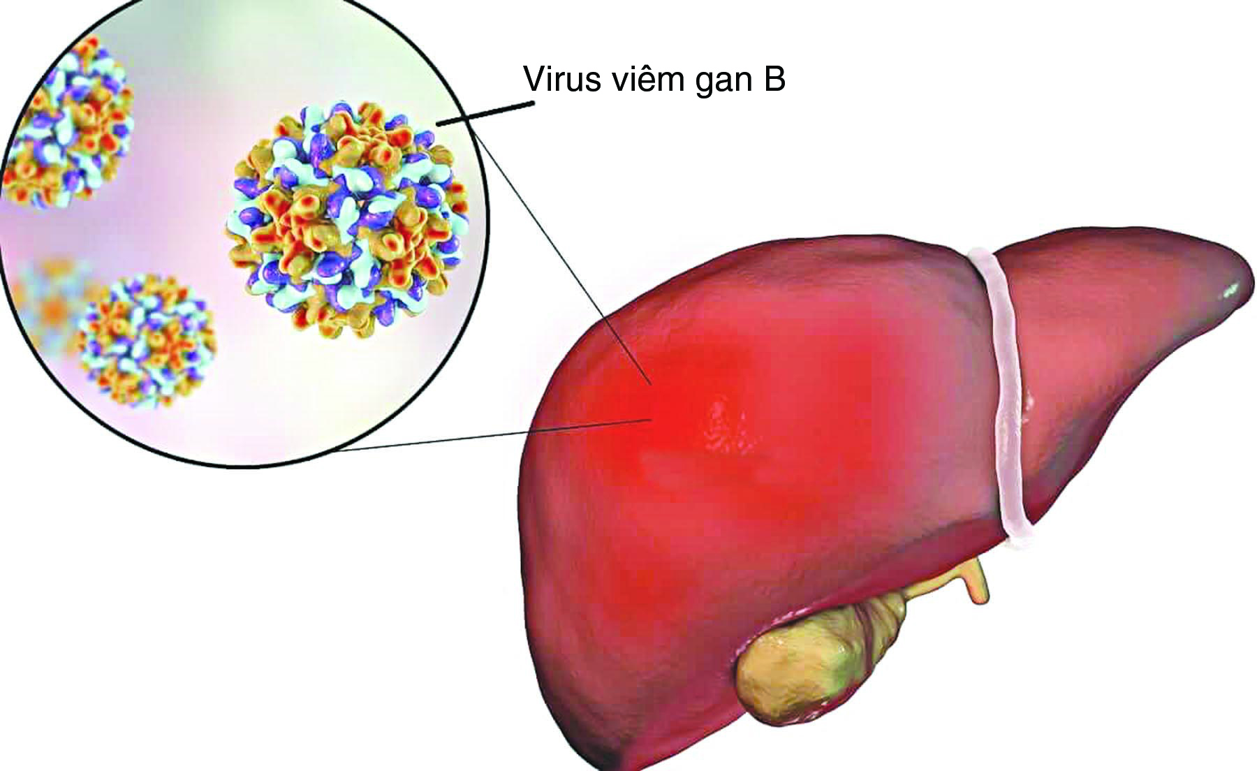 Điều trị bệnh viêm gan B-1