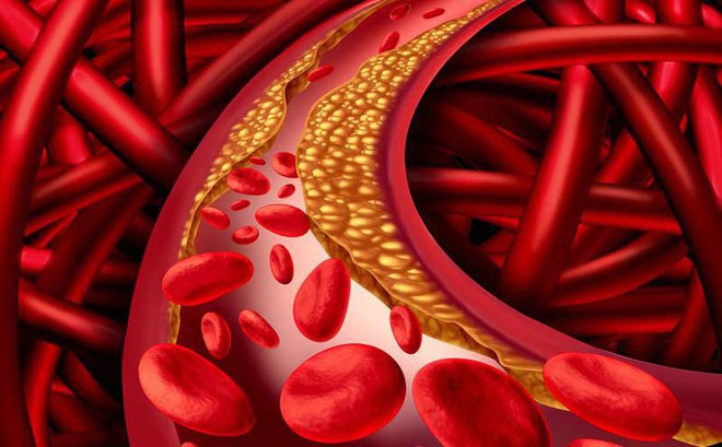 Tìm hiểu tăng cholesterol máu ở người cao tuổi-1