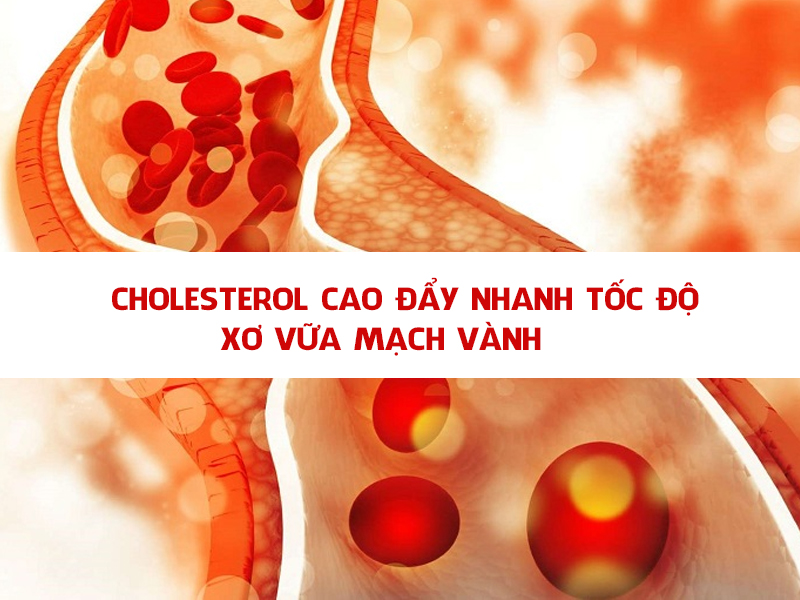 Cholesterol cao đẩy nhanh tốc độ xơ vữa mạch-1