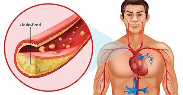 Cholesterol cao đẩy nhanh tốc độ xơ vữa mạch-2