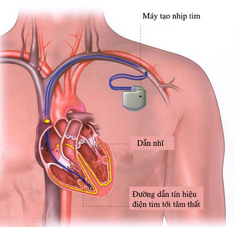 Cảnh giác các dấu hiệu nghiêm trọng của bệnh tim mạch