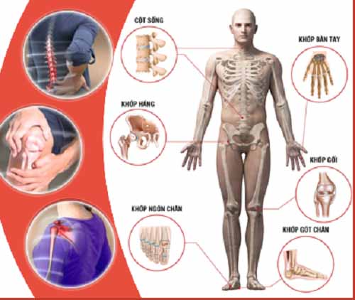 Bệnh cơ xương khớp - Nguyên nhân hàng đầu gây tàn phế