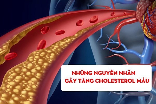 [TOP] 6 nguyên nhân gây tăng cholesterol máu