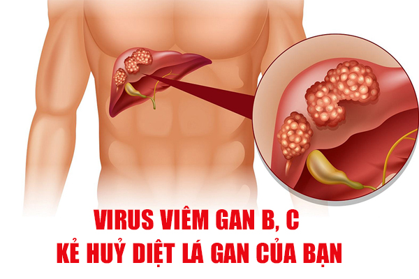 Virus viêm gan B, C – kẻ huỷ diệt lá gan của bạn