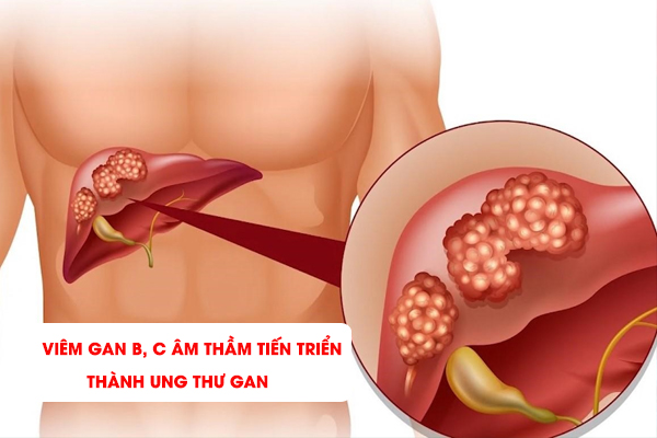 [CẢNH BÁO] Viêm gan B, C âm thầm tiến triển thành ung thư gan