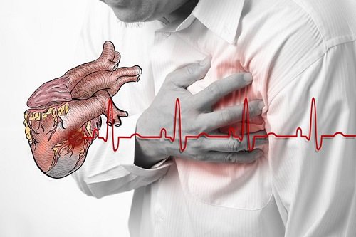 Thiếu máu cơ tim: Nguyên nhân, triệu chứng và những yếu tố nguy cơ gây bệnh